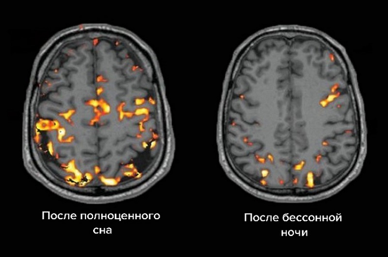 Бессонница и недостаток сна снижают активность мозга в три раза Бессонница и недостаток сна снижают активность мозга в три раза